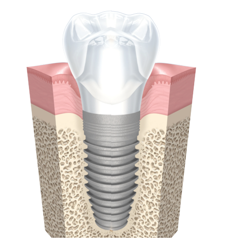 implant-dent