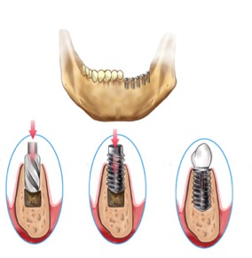 implant-dentaire