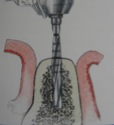 pose-implant2